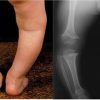 انواع بیماری استخوان در کودکان، انواع، تشخیص و درمان آن